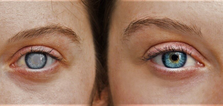 Сучасне лікування катаракти – як повернути чіткість зору?