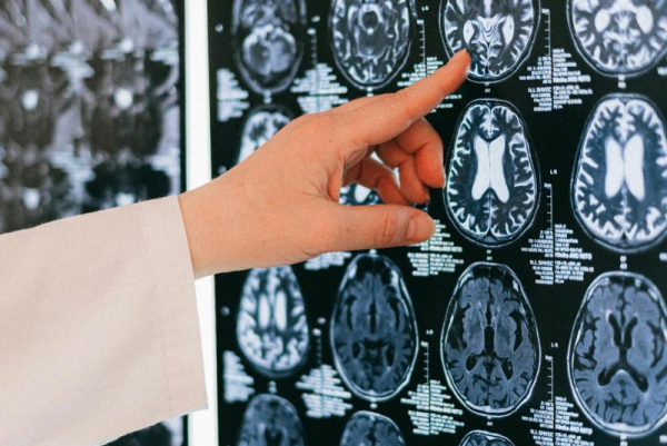 Researchers have identified a brain biomarker that could allow Alzheimer's disease to be detected decades before symptoms appear. Photo by Anna Shvets/Pexels