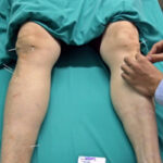 Дослідники розглядають опромінення як можливий метод лікування артриту…