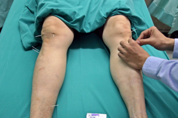 People with mild to moderate wear-and-tear knee arthritis felt less pain and had better mobility after low-dose radiation treatment, researchers reported. File Photo by Rungroj Yongrit/EPA