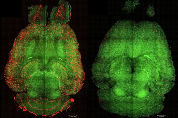 Before-and-after fluorescence microscope images of a mouse brain show red-colored build-ups of toxic amyloid beta plaque (L) and the same brain 12 hours after being treated with nanoparticles. Spanish and Chinese scientists say their nanoparticle experiments could create a new focus on the blood-brain barrier in treating Alzheimer's disease. Image courtesy Institute for Bioengineering of Catalonia