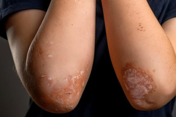 The severe stress caused by family upheaval might tax a child's immune system in ways that increase their chances of autoimmune skin disease psoriasis, researchers said. Photo by Adobe Stock/HealthDay News
