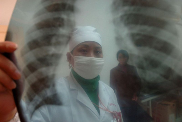 Рак легень залишається провідною причиною смерті від раку, але досягнення у скринінгу, хірургії та персоналізованому лікуванні допомагають пацієнтам жити довше. Фото з архіву: Шоу Шенг/EPA Lung cancer remains the leading cause of cancer death, but advances in screening, surgery and personalized treatment are helping patients live longer. File Photo by Shou Sheng/EPA