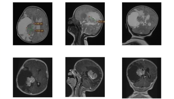 У Львові вилікували двомісячне дитя з церебральною пухлиною.