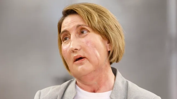 Жінці з хворобою плотоядства пересадили обличчя від донора, який&hellip;