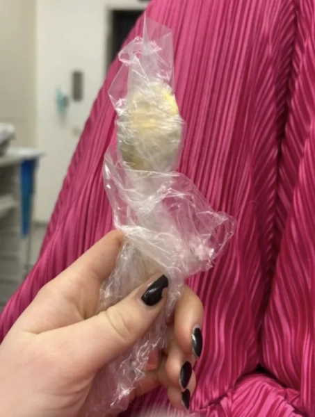 Історія з Jam Press (Жінка ковтає ложку). На фото: ложка Реймі Амелінкс, яку вона зберегла. «Я випадково проковтнула 17-сантиметрову ложку, поки їла йогурт? Мені було надто соромно сказати своєму хлопцеві». Жінка випадково проковтнула 17-сантиметрову ложку, коли її собака стрибнув їй на коліна, поки вона їла йогурт. Реймі Амелінкс сказала, що їй довелося вибирати між «задиханням чи ковтанням ложки». Вона відчула, як інструмент «плавно ковзає мені в шлунок». 28-річна жінка сказала, що сиділа на дивані з йогуртом, коли її енергійна угорська візла на ім'я Марлі раптово стрибнула на неї. «Я поклала ложку в рот, щоб звільнити руки та відповісти на повідомлення», — розповіла Реймі, яка родом з Румста в Бельгії, «Що таке варення». «Саме тоді Марлі вирішила стрибнути на мене. «Я так злякалася, що різко відкинула голову назад, і перш ніж я це усвідомила, ложка застрягла у мене в горлі. «Я встала і почала панікувати». Спочатку Реймі, яка працює медичним представником, спробувала вийняти ложку рукою. «Але все сталося так швидко, що це було або ковтання, або задуха», – сказала вона. Коли її хлопець повернувся з роботи, вона сказала, що їй було надто соромно сказати йому, тому вона «вдала, що нічого не сталося». «Мені зовсім не було погано», тому я одразу нічого про це не сказала. «Лише після вечері я зрозуміла, що це насправді досить серйозно. «У моєму шлунку була 17-сантиметрова ложка. В інтернеті скрізь казали одне й те саме: негайно йдіть до відділення невідкладної допомоги. Тільки тоді я зрозуміла, наскільки це може бути небезпечно». Лікарі сказали їй, що ложка занадто велика, щоб вивести її природним шляхом, тому їй довелося повернутися додому та чекати, поки можна буде призначити гастроскопію. Реймі сказала: «Та ніч була важкою, я відчувала, як ложка рухається, іноді навіть між ребрами. Це було справді жахливо». «Я відчувала здуття живота та нудоту, і не могла їсти, не відчуваючи дивних відчуттів. Спати було важко, бо кожна постава нагадувала мені ложку в шлунку». Приладдя видалили через два дні під місцевою анестезією. «Мені не дозволяли ковтати, поки його витягували», – сказала Реймі. «Їм довелося обертати його в шлунку, що спричинило невелику шлункову кровотечу. Це було неприємно, але я відчула справжнє полегшення, коли його витягли». Вона додала: «Я так рада, що ложку врешті-решт видалили за допомогою гастроскопії, і що їм не довелося хірургічно розрізати мій шлунок». Через кілька годин ковтальниці ложки дозволили повернутися додому. «Після видалення я швидко одужала», – сказала вона. «У мене боліло горло через пошкодження стравоходу, було кілька незначних шлункових кровотеч і деякий час був чутливий шлунок, але без постійних пошкоджень. «Однак я здобула довічну репутацію «тієї дівчини з ложкою»». Вона додала: «Наступного дня я повернулася до роботи, як завжди. Мої колеги не повірили мені, доки я не показала їм рентгенівський знімок». Незважаючи на неприємний досвід, Реймі вирішила зберегти ложку, про яку йде мова, як пам’ять. «Мій хлопець хоче перетворити її на витвір мистецтва», – сказала вона. «Він ще не знає точно, що саме, але це точно буде унікальний твір. «Це найменше, чого заслуговує така пригода». Реймі поділилася порадами для таких же любителів собак та йогурту — або тих, хто думає про те, щоб відмовитися від використання столового прибору для надсилання повідомлень. Вона сказала: «Захоплені собаки + їжа на колінах = зона ризику. Навчіть їх команді «чекати» або «тихо» для моментів стрибка. Для тих, хто їсть йогурт: не їжте, тримаючи столові прибори повністю в роті. Не виконуйте багато завдань одночасно з тваринами та уникайте переляку від стрибків та сміху з повним ротом. Якщо ви проковтнули щось, чого насправді там не повинно бути: негайно зверніться за медичною допомогою. Збентеження тимчасове, внутрішні пошкодження — ні». Реймі додала: «Це дивна історія, але зі щасливим кінцем — і легендарний анекдот для вечірок». КІНЕЦЬ ПРИМІТКА РЕДАКТОРА: Ліцензія на використання відео: (НЕВИКЛЮЧНА) Ми отримали невиключну ліцензію від власника авторських прав. Копія ліцензії доступна за запитом. Обмеження відео: Немає.